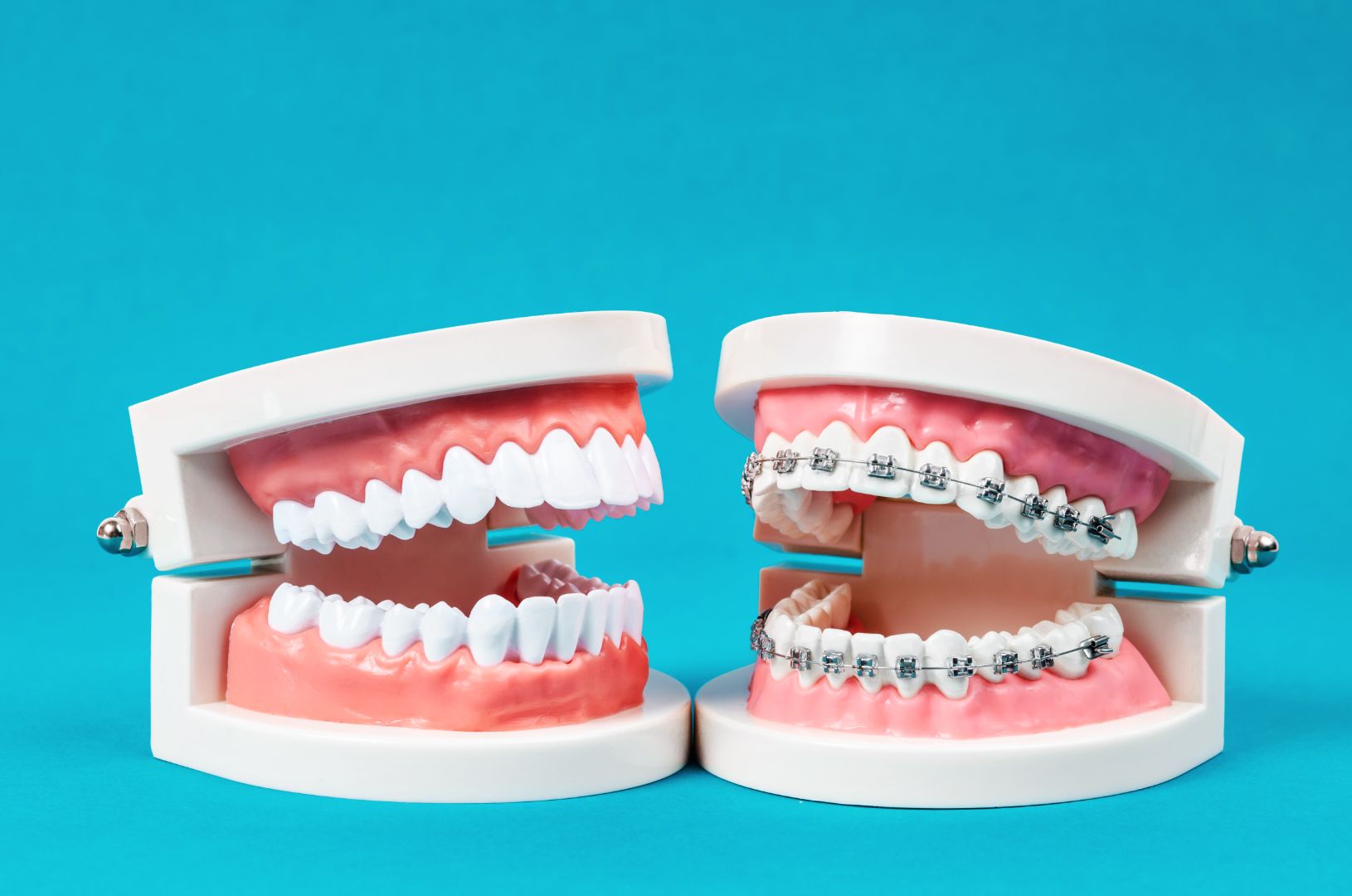 Braces vs. Invisalign